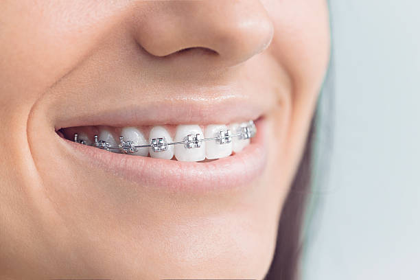 Best Traditional Braces  in Tye, TX